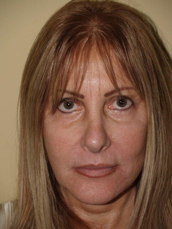 Revision Rhinoplasty