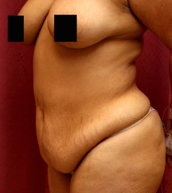 tummy tuck