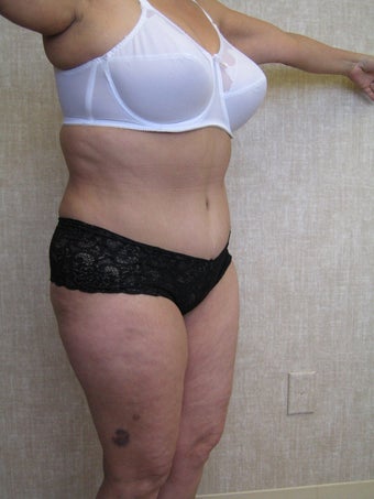 tummy tuck