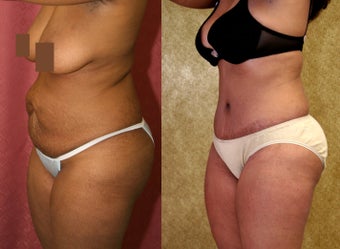 tummy tuck 