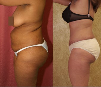 tummy tuck 