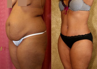 tummy tuck