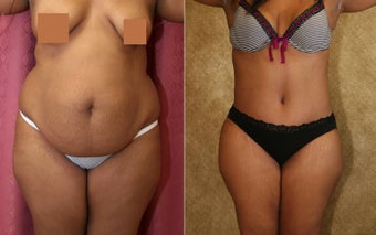tummy tuck