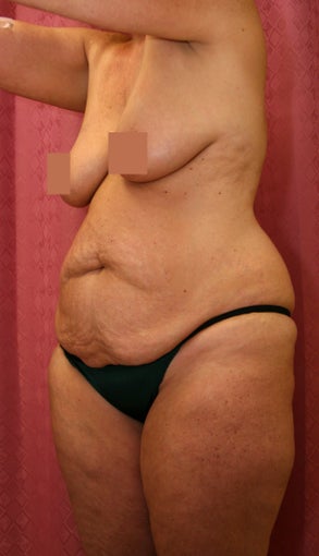 tummy tuck
