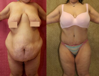 tummy tuck
