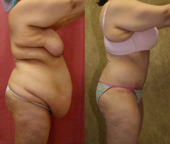 tummy tuck