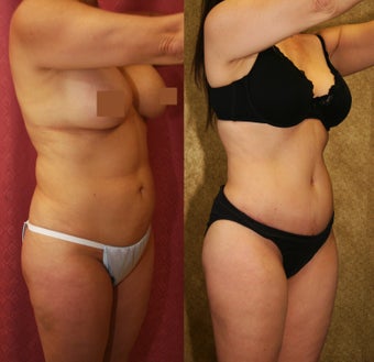 tummy tuck