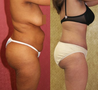 tummy tuck