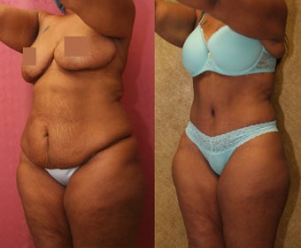 tummy tuck
