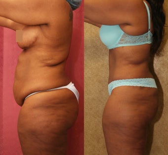 tummy tuck