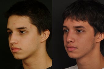 Rhinoplasty