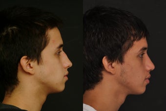 Rhinoplasty