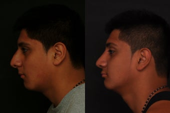 Rhinoplasty