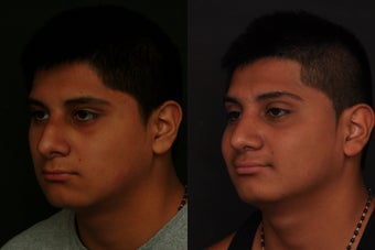Rhinoplasty
