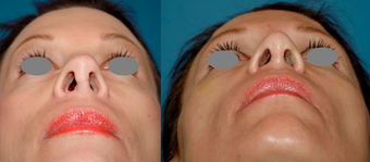 Revision Rhinoplasty (open)