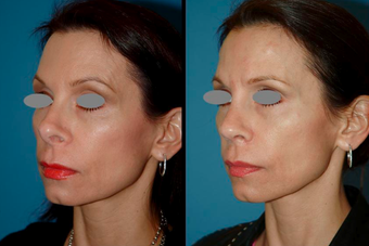 Revision Rhinoplasty (open)