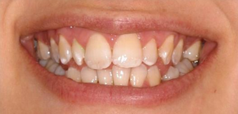 Invisalign