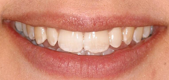 Invisalign