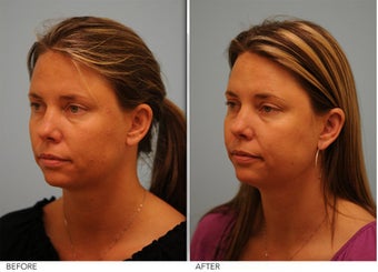 Otoplasty