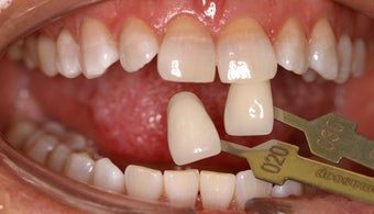 Teeth Whitening