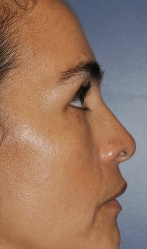 Lower lid blepharoplasty and Fat Transfer to lower lids and midface