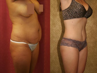 tummy tuck