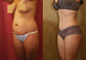 tummy tuck