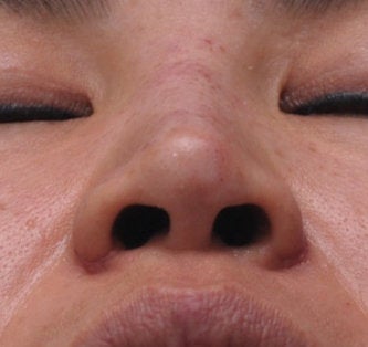 Non Surgical Rhinoplasty
