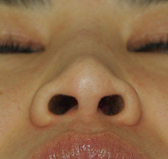 Non Surgical Rhinoplasty