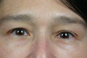 Restylane to Tear Trough