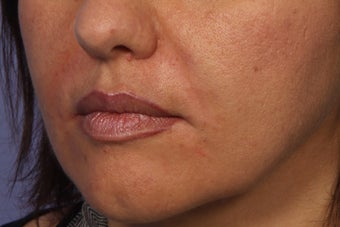 Radiesse to Smile Lines (nasolabial folds)