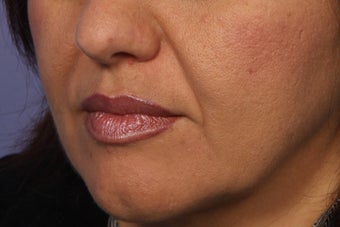 Radiesse to Smile Lines (nasolabial folds)