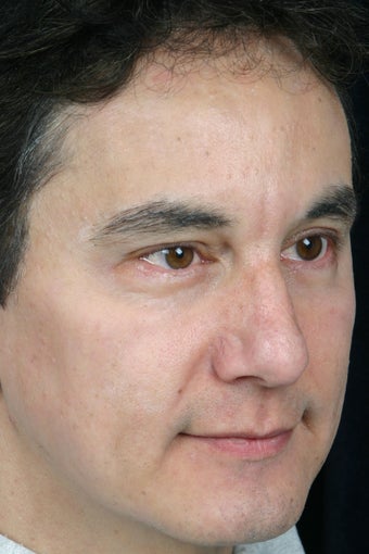 Pearl, Botox and Juvederm to Glabella (between eyes)