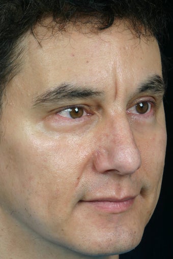 Pearl, Botox and Juvederm to Glabella (between eyes)
