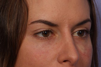 Restylane to Tear Troughs (under eyes)