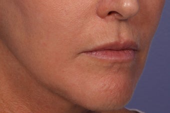 Botox and Juvederm Ultra Plus to Upper Lip