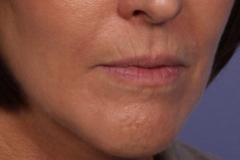 Botox and Juvederm Ultra Plus to Upper Lip