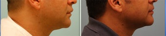 Male Upper Lip Reduction