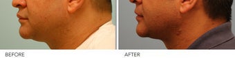 Male Upper Lip Reduction