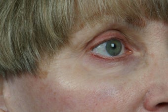 Botox 