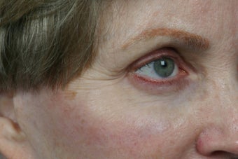 Botox 