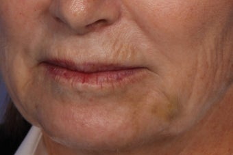 Botox and Juvederm 