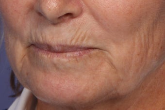 Botox and Juvederm 