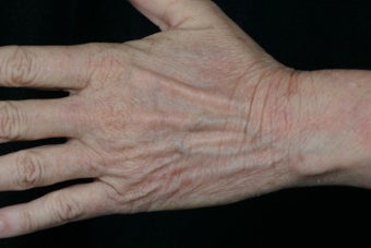 Dual Fraxel  Laser 