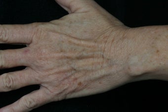 Dual Fraxel  Laser 