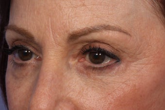 Restylane 