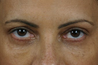 Restylane 