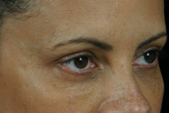 Restylane 