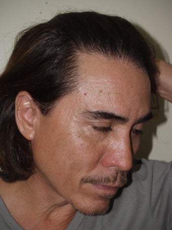 Hairline Advancement