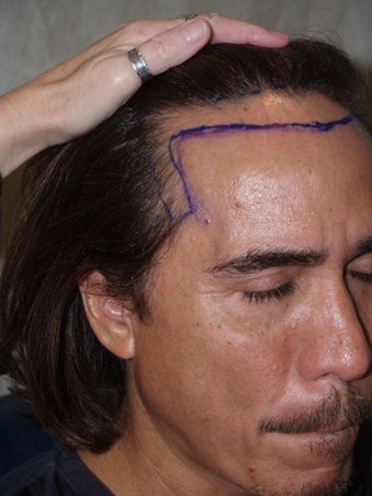 Hairline Advancement